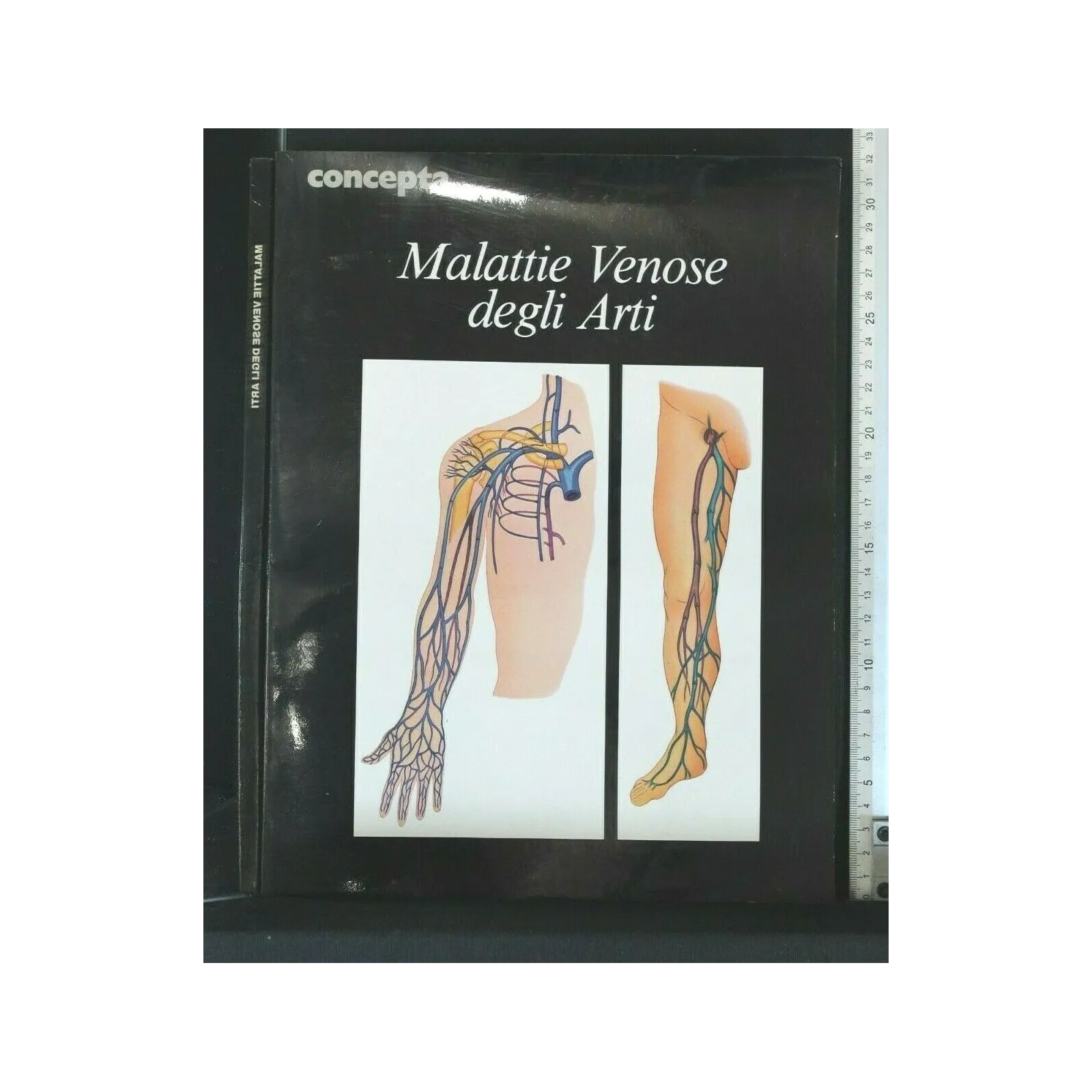 MALATTIE VENOSE DEGLI ARTI