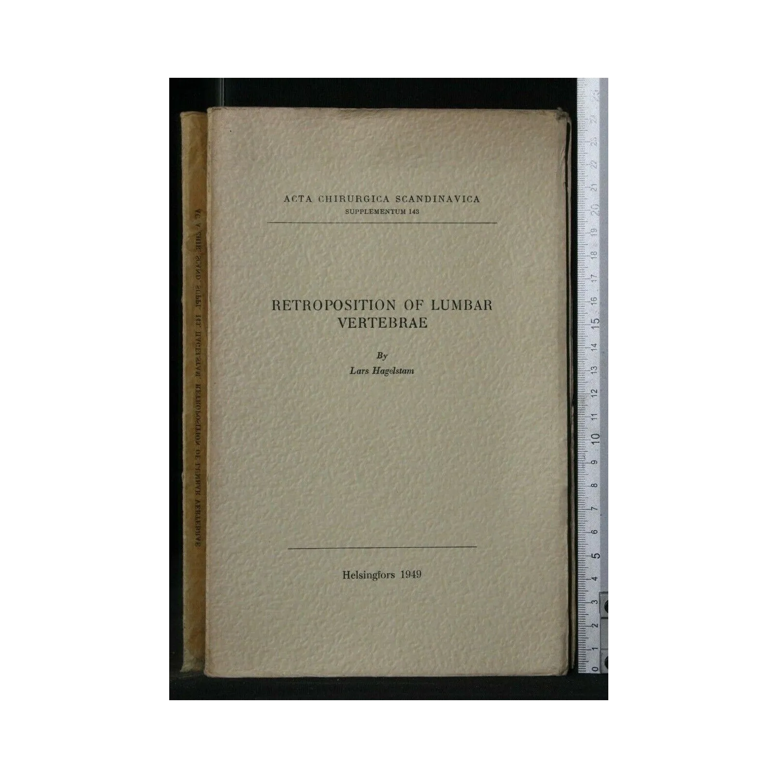 RETROPOSITION OF LUMBAR VERTEBRAE