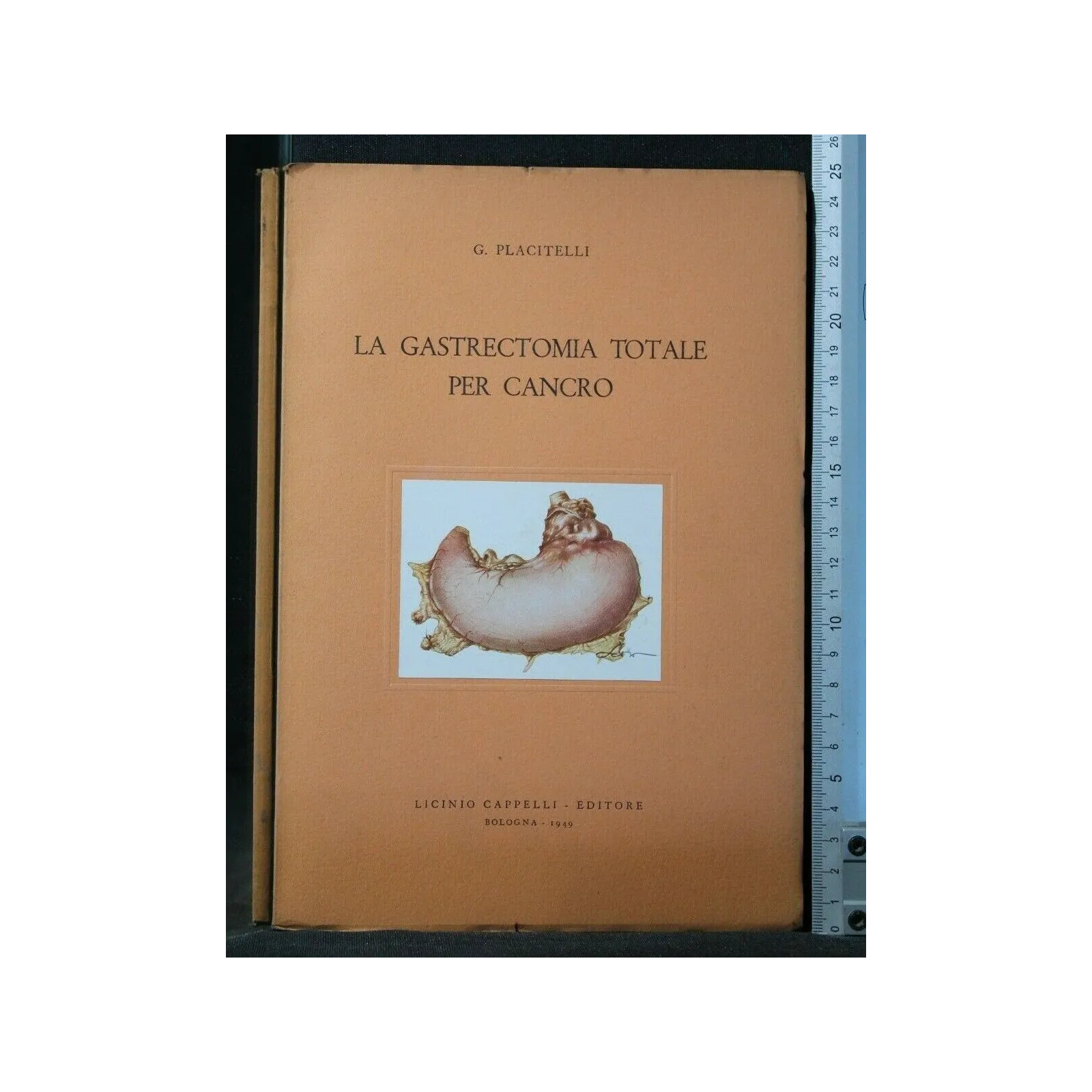 LA GASTRECTOMIA TOTALE PER CANCRO