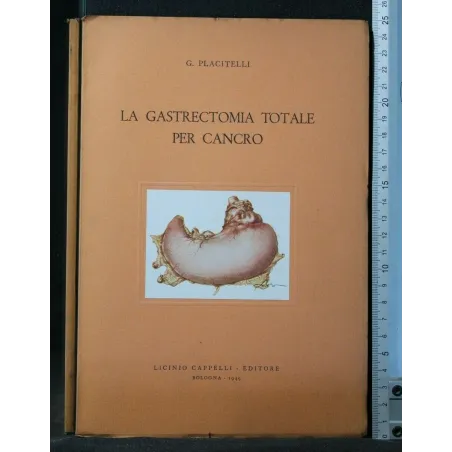 LA GASTRECTOMIA TOTALE PER CANCRO