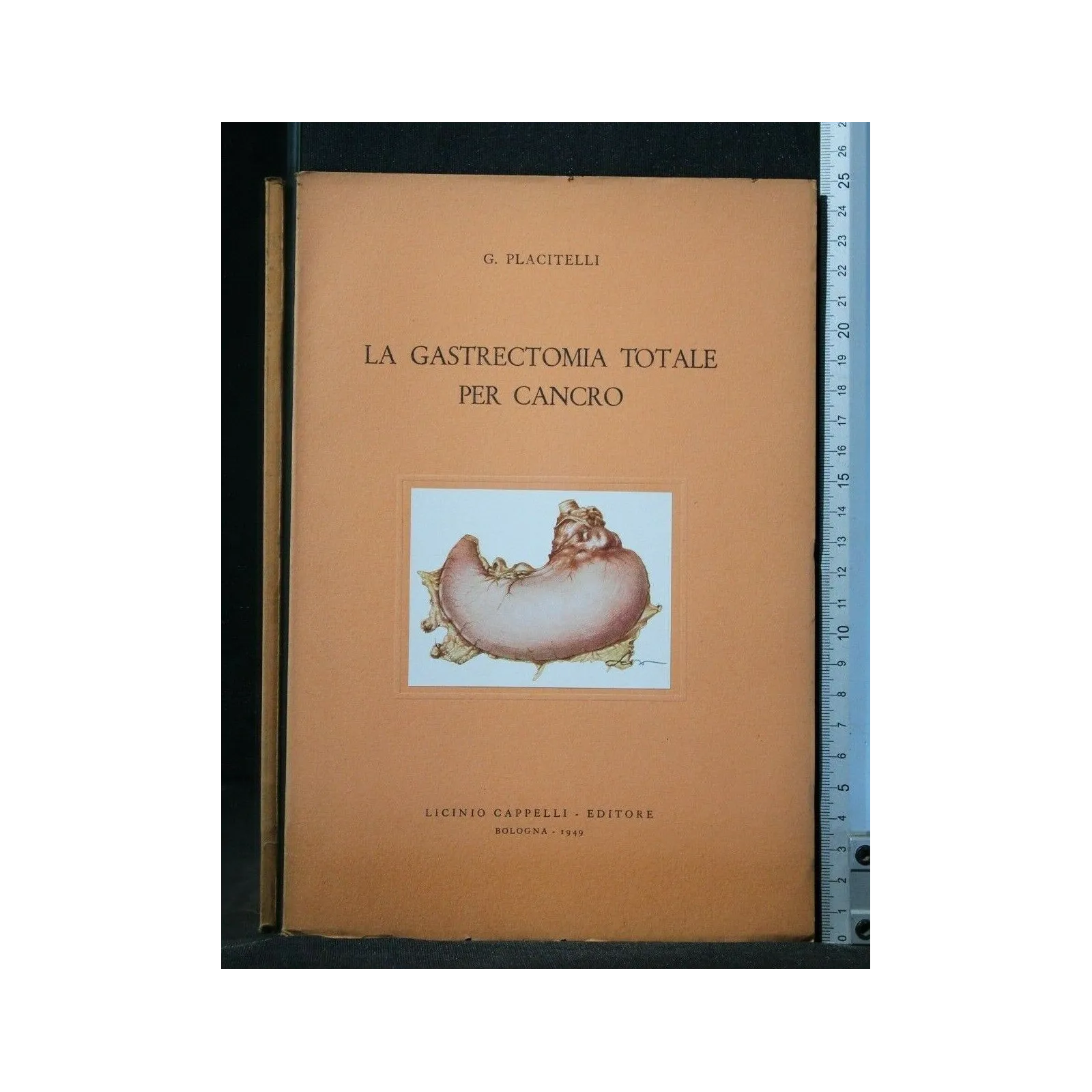 LA GASTRECTOMIA TOTALE PER CANCRO