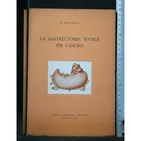 LA GASTRECTOMIA TOTALE PER CANCRO