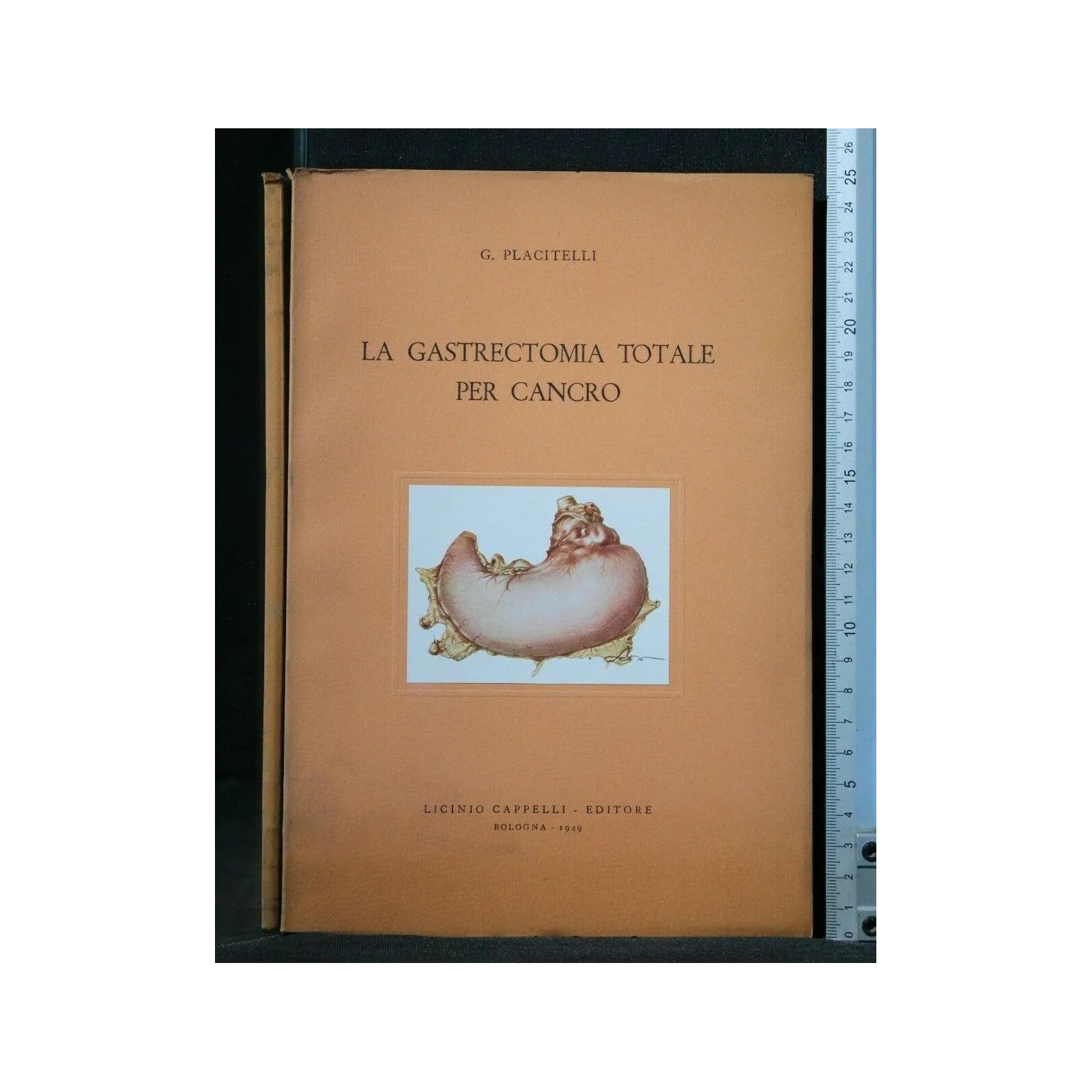 LA GASTRECTOMIA TOTALE PER CANCRO