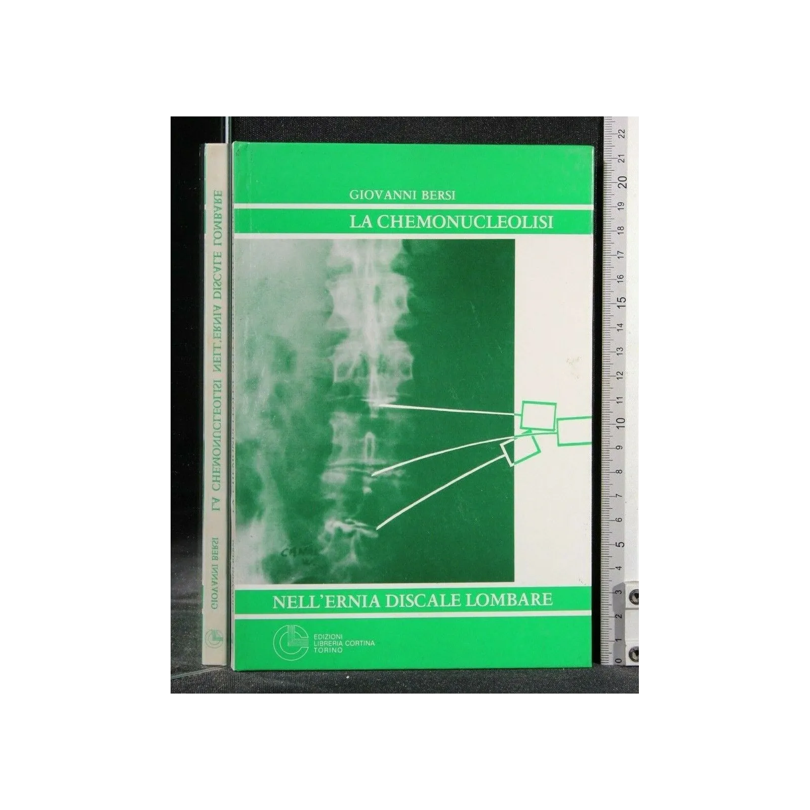 LA CHEMONUCLEOLISI NELL'ERNIA DISCALE LOMBARE