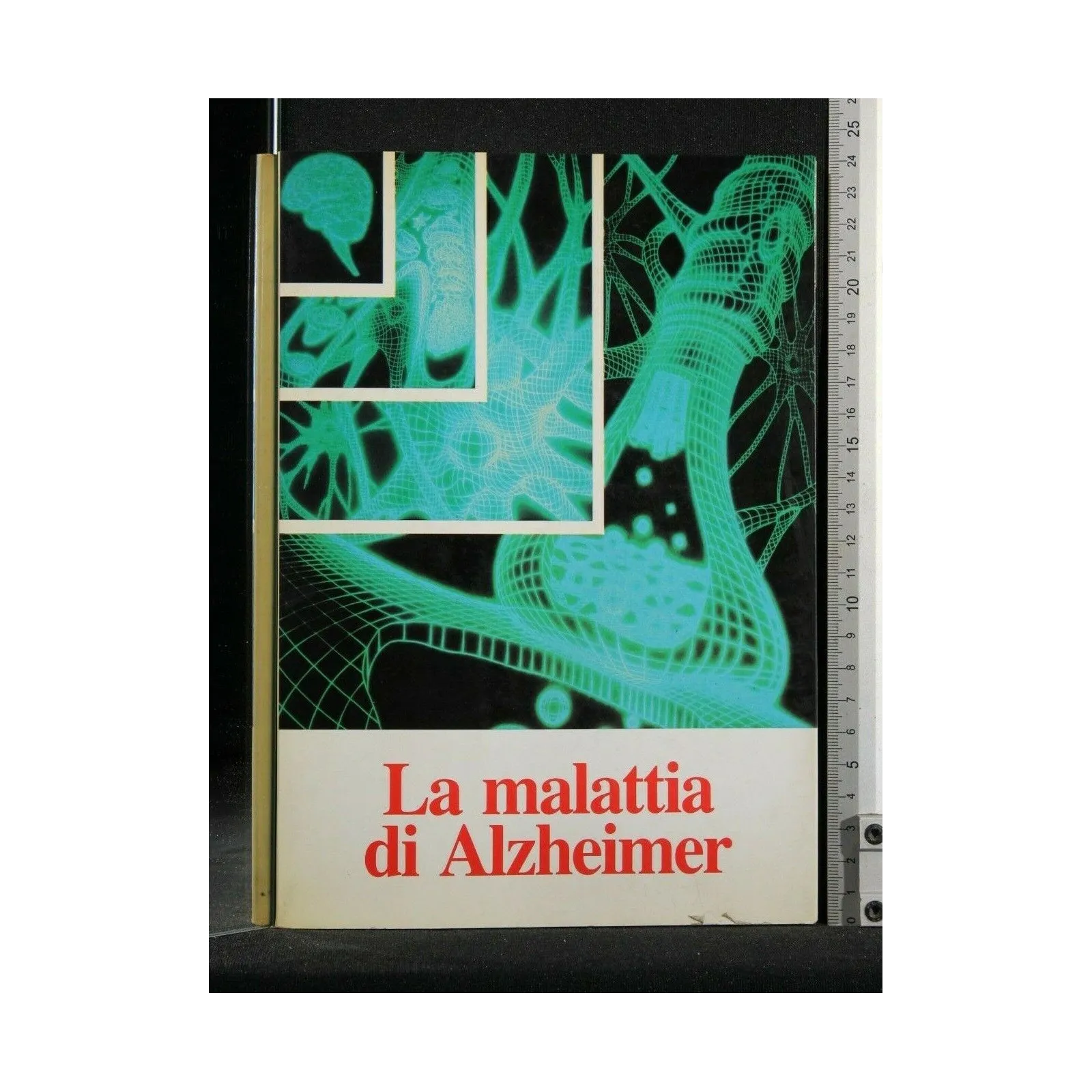 LA MALATTIA DI ALZHEIMER _x000D_