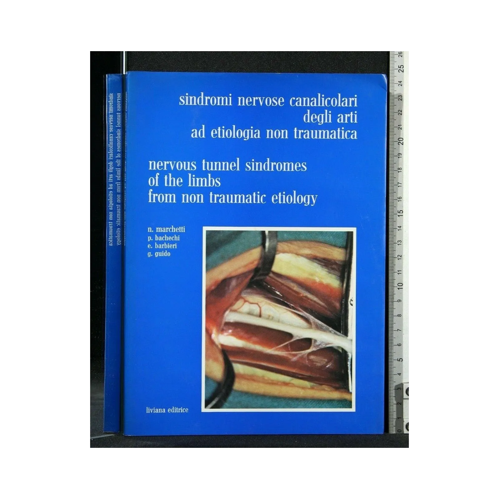 SINDROMI NERVOSE CANALICOLARI DEGLI ARTI ED ETIOLOGIA NON