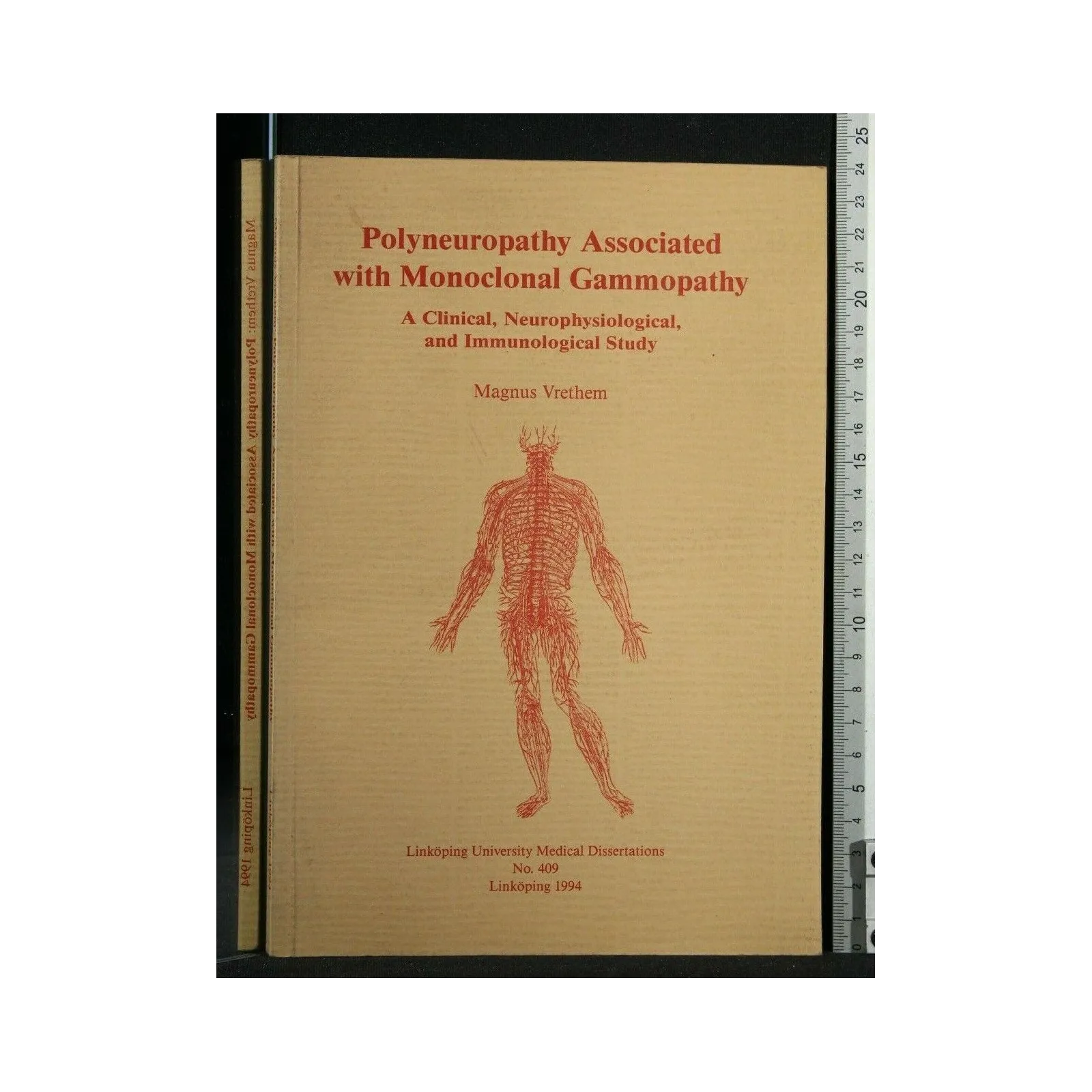 POLYNEUROPATHY ASSOCIATED WITH MONOCLONAL GAMMOPATHY