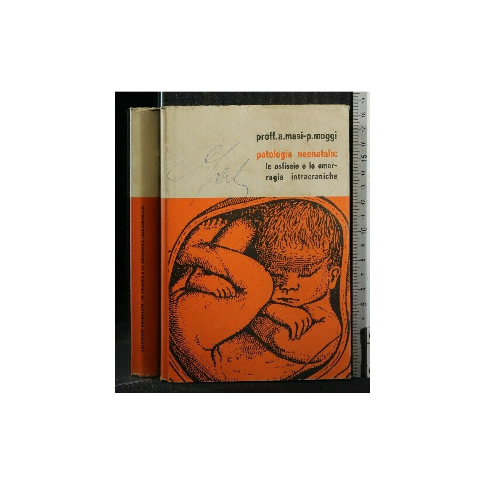 PATOLOGIA NEONATALE: LE ASFISSIE E LE EMORRAGIE INTRACRANICHE