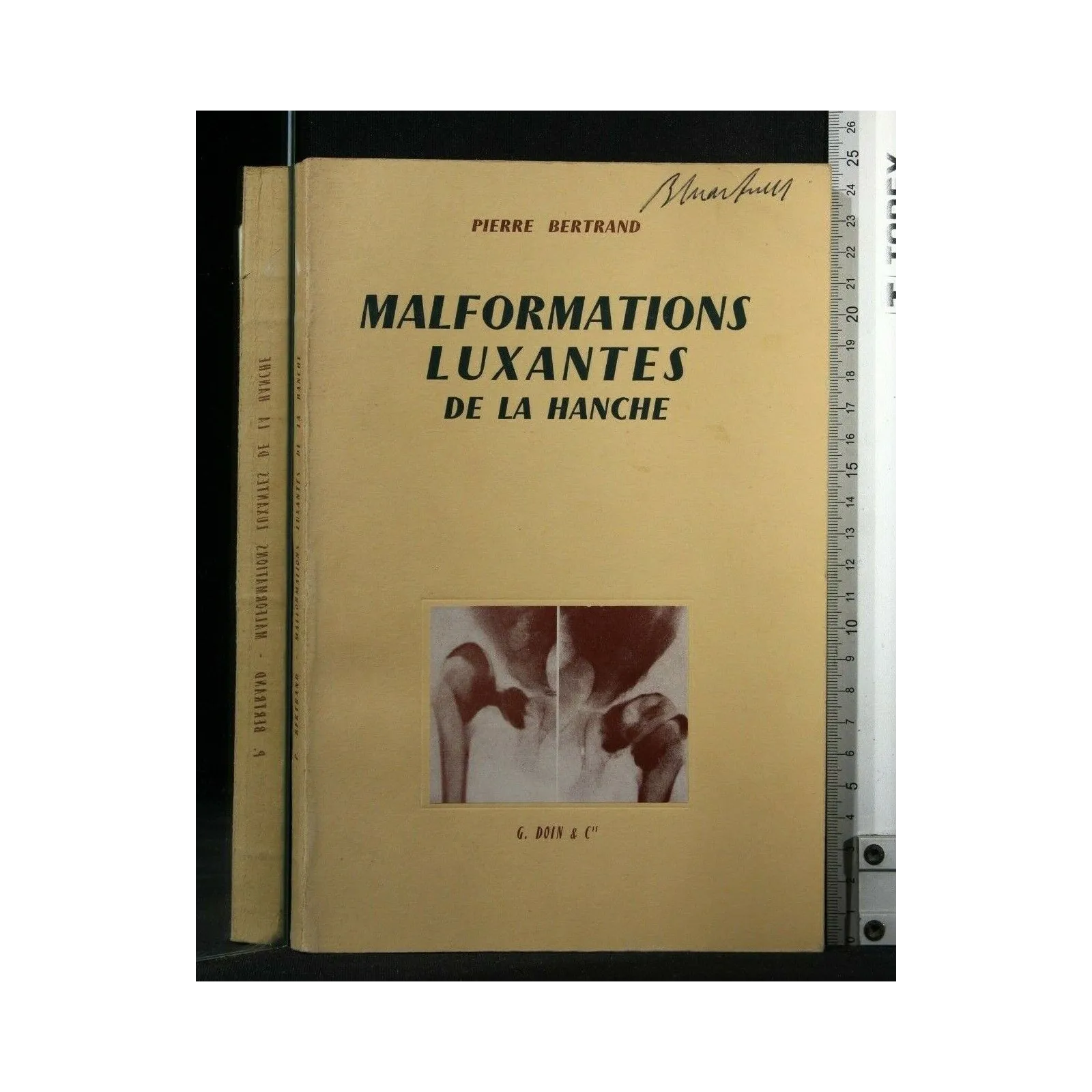 MALFORMATIONS LUXANTES DE LA HANCHE