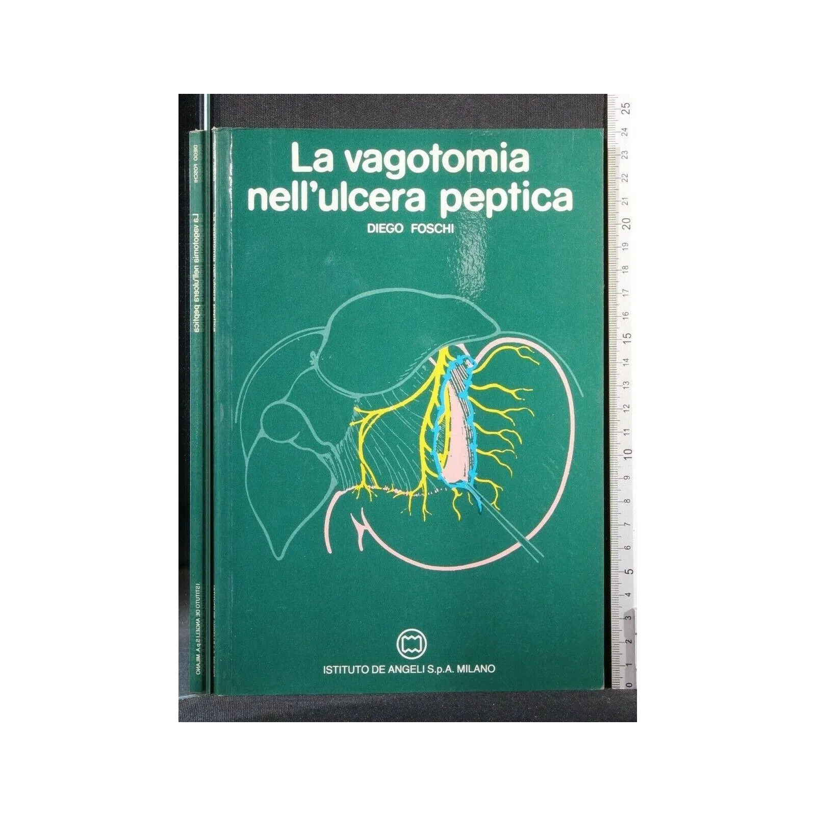 LA VAGOTOMIA NELL'ULCERA PEPTICA