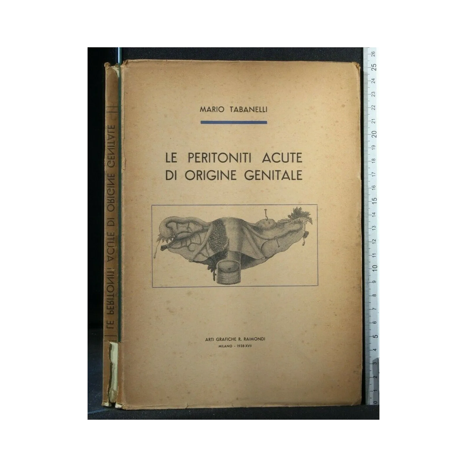 LE PERITONITI ACUTE DI ORIGINE GENITALE