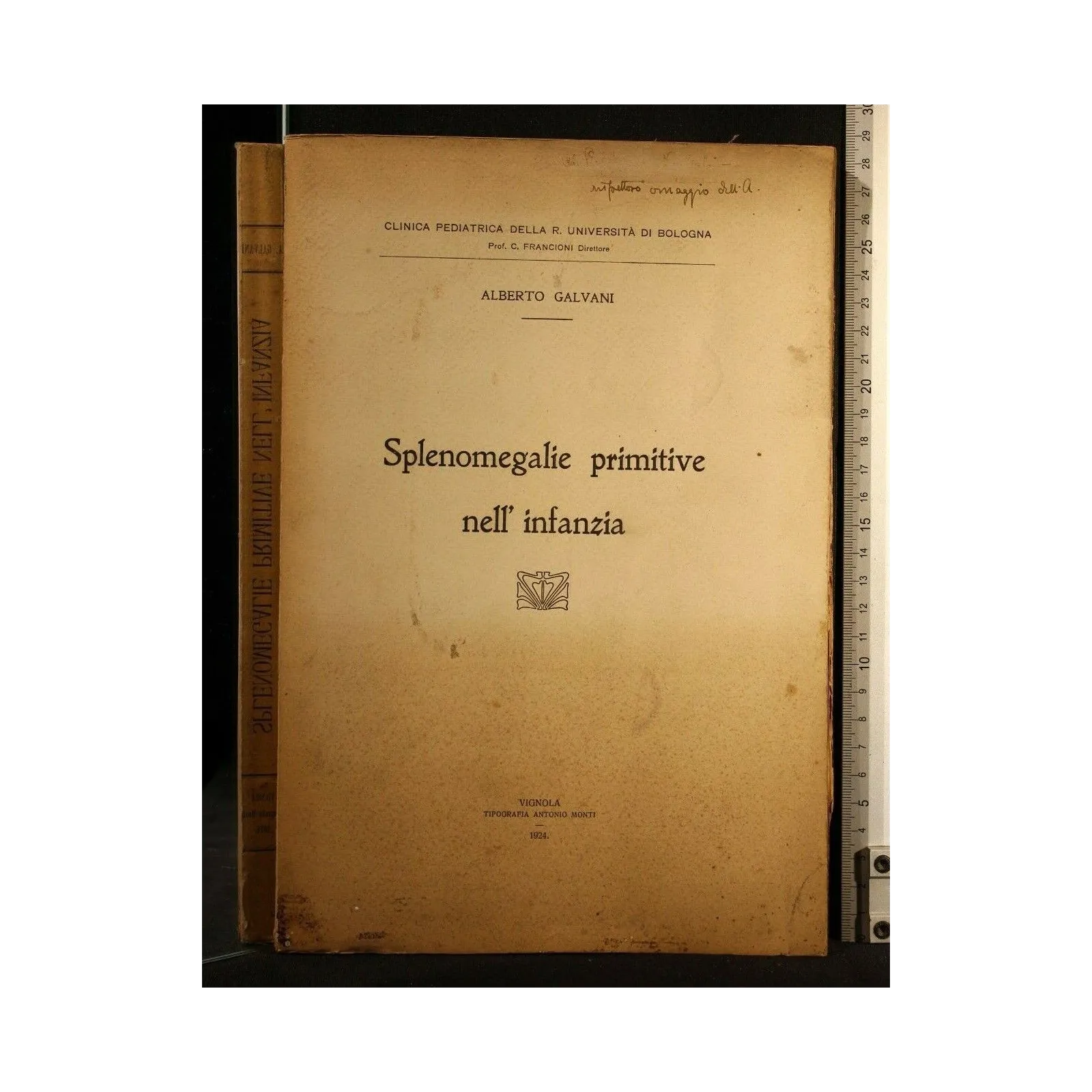 SPLENOMEGALIE PRIMITIVE NELL'INFANZIA