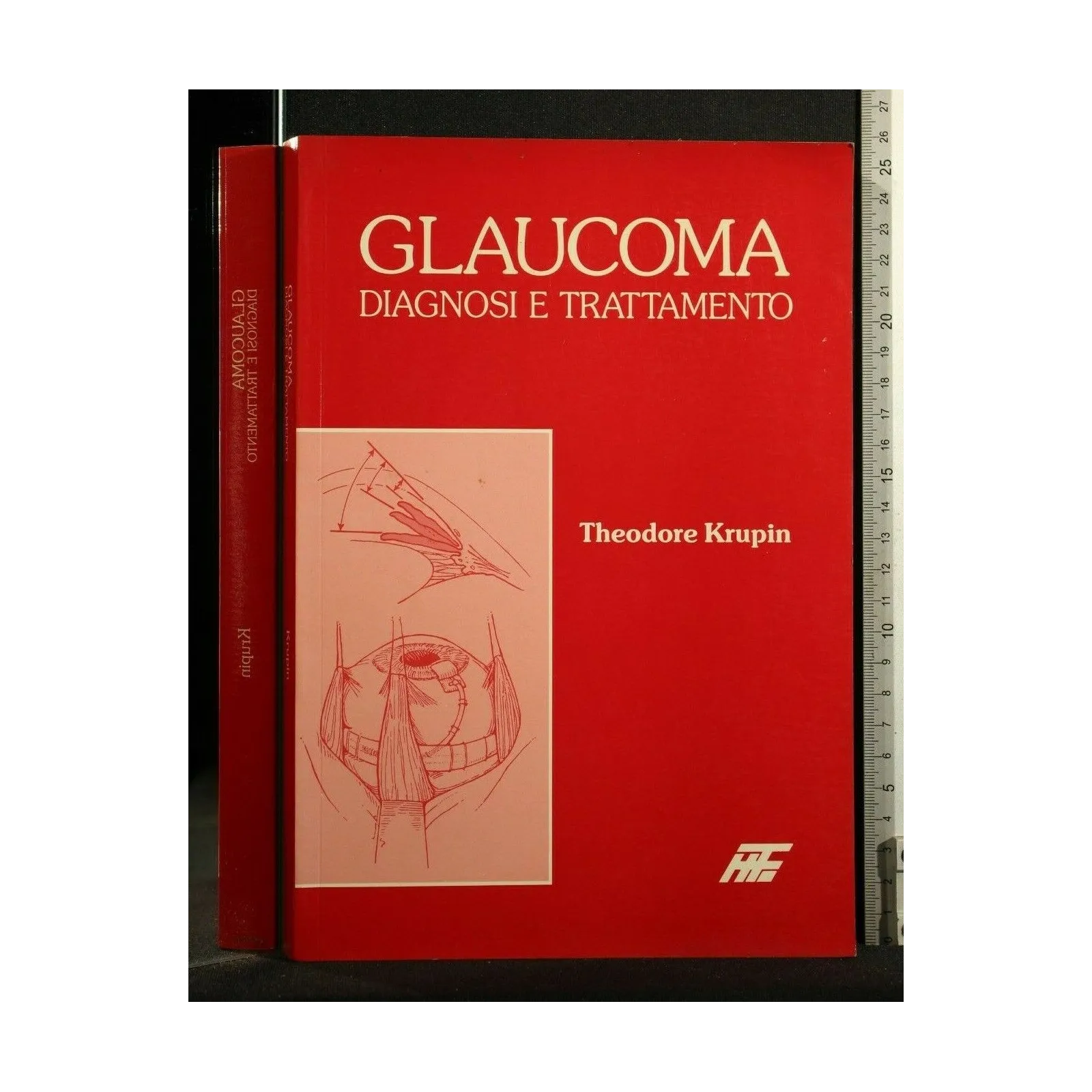 GLAUCOMA DIAGNOSI E TRATTAMENTO