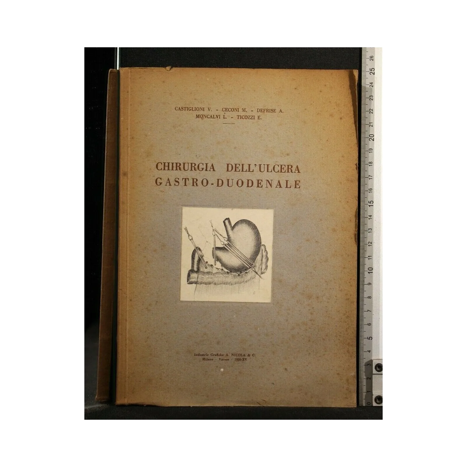 CHIRURGIA DELL'ULCERA GASTRO-DUODENALE