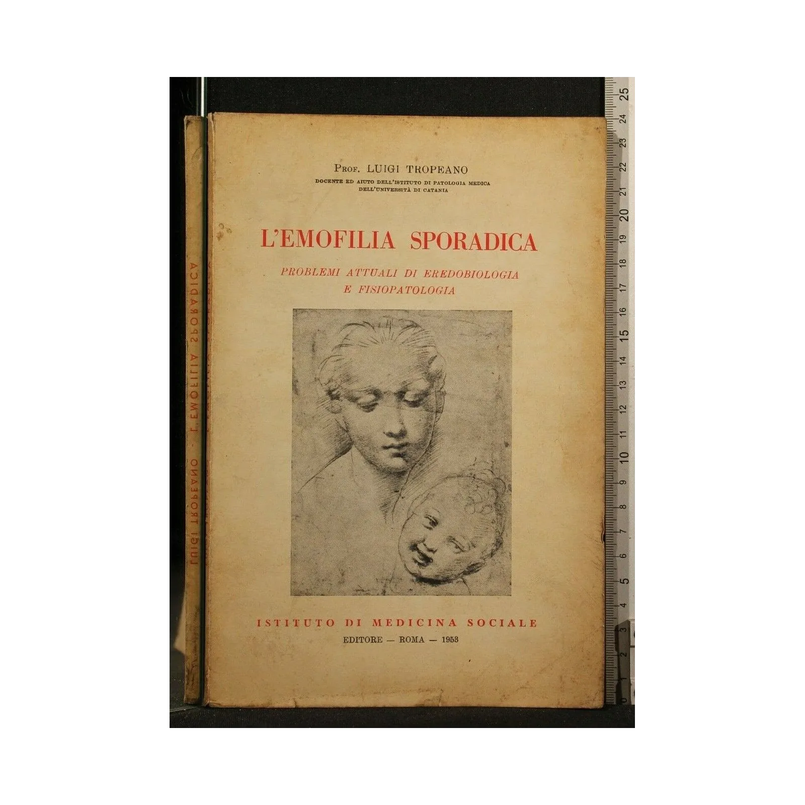 L'EMOFILIA SPORADICA